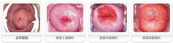 治疗宫颈糜烂手术需要多少钱?深思!反思!