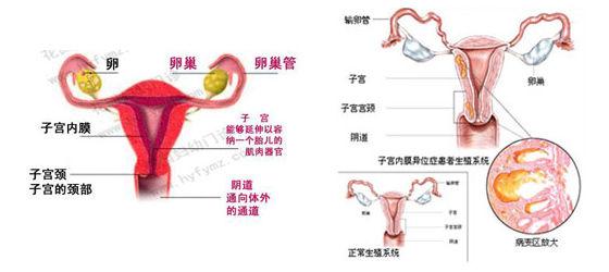 子宫内膜异位症有什么症状