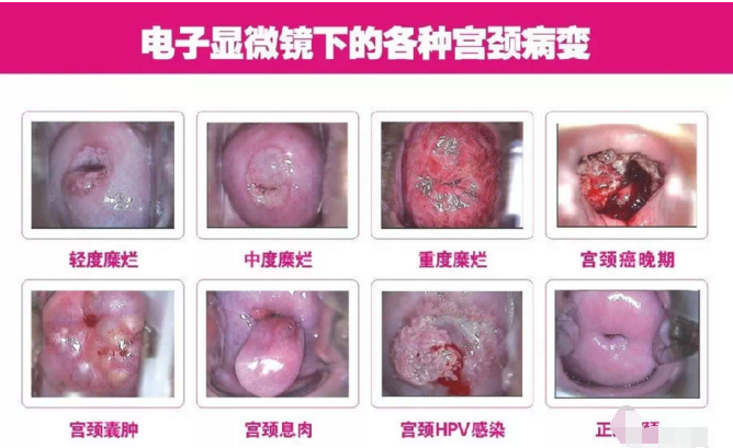 细数:宫颈炎对女性健康的六大危害