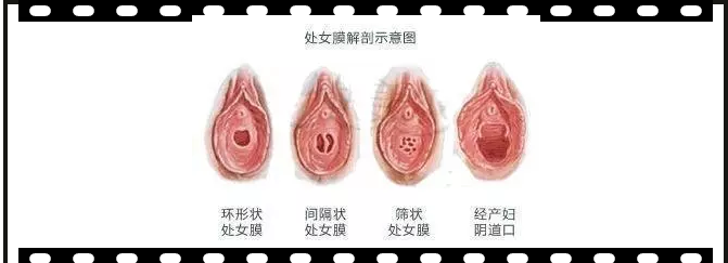 妇科医院处女膜修复手术,做自信少女如花绽放