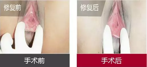 妇科医院处女膜修复手术,做自信少女如花绽放