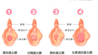 处女膜修复术前术后注意点有哪些?