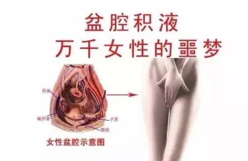 引起女性盆腔积液的4个“凶手”