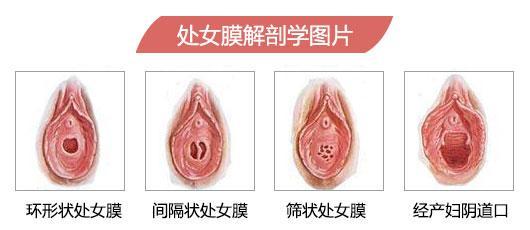天津静海做处女膜修复前有什么注意事项?